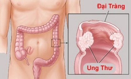 Tuyệt đối tránh xa 6 thực phẩm này nếu bạn không muốn bị ung thư đại tràng