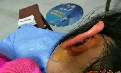 Bé gái lớp 2 bị cô giáo véo đứt tai vì chưa làm bài tập