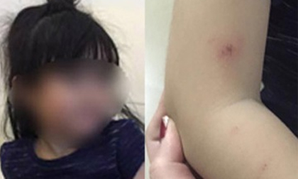 Phụ huynh bức xúc tố cô giáo trường MN quốc tế đánh con gái 3 tuổi trầy xước khắp người