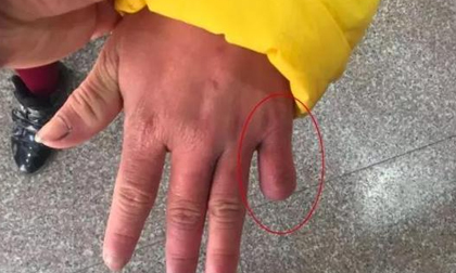 Bé gái 12 tuổi bị mẹ đẻ dùng kéo cắt ngón tay, châm thuốc lá đốt da