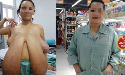 Hình ảnh mới nhất về người phụ nữ có bộ ngực khổng lồ sau khi phẫu thuật
