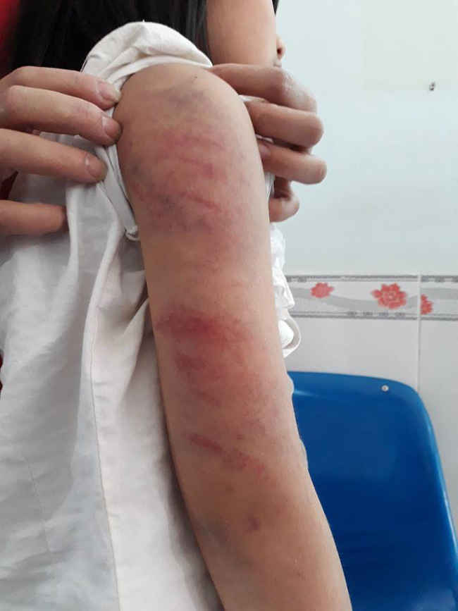 Vĩnh Phúc: Bố say rượu đánh con gái 6 tuổi bầm dập khắp cơ thể phải đi bệnh viện - Ảnh 4.