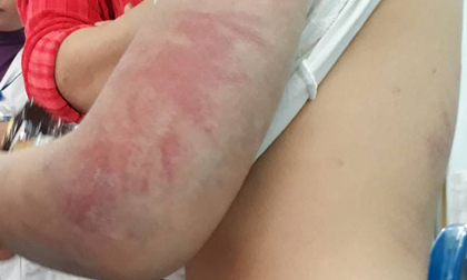 Vĩnh Phúc: Bố say rượu đánh con gái 6 tuổi bầm dập khắp cơ thể phải đi bệnh viện