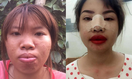 Bị bạn bè xa lánh vì ngoại hình xấu xí, bà mẹ đơn thân ở Đắk Nông quyết 'đập mặt làm lại'