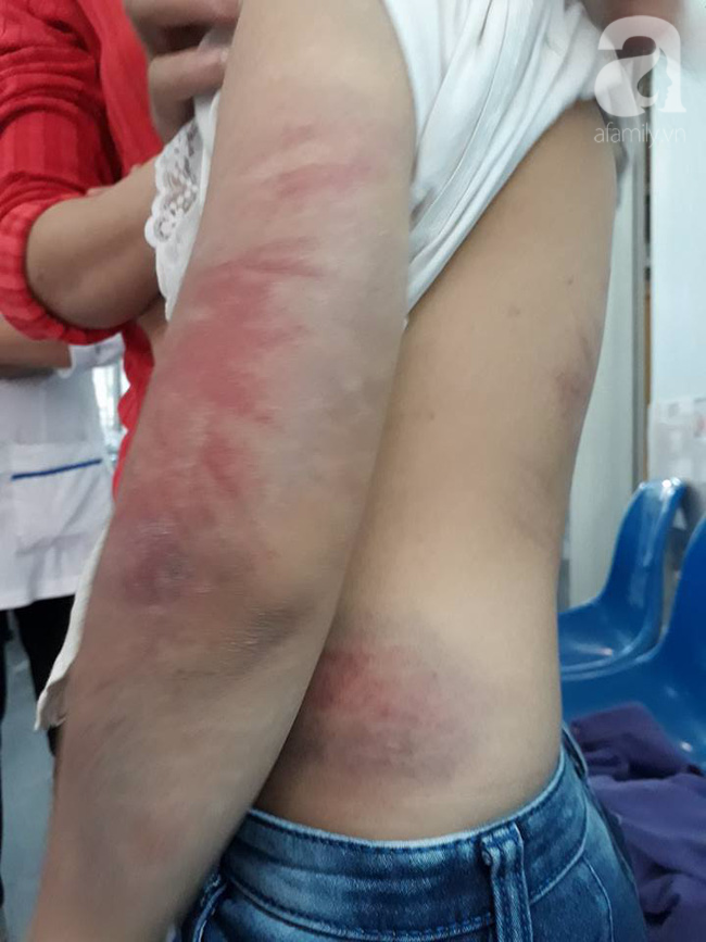 Vụ bé gái 10 tuổi bị bố đánh bầm tím toàn thân: Người mẹ nhiều lần bị chồng đánh đập - Ảnh 2. Vụ bé gái 10 tuổi bị bố đánh bầm tím toàn thân: Người mẹ nhiều lần bị chồng đánh đập - Ảnh 2.