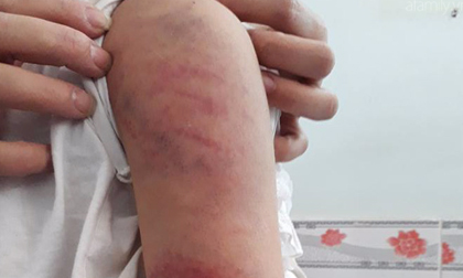 Vụ bé gái 10 tuổi bị bố đánh bầm tím toàn thân: Người mẹ nhiều lần bị chồng đánh đập