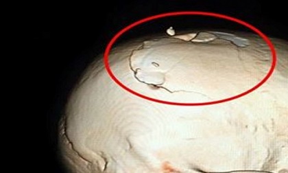 Cứu chữa thành công bệnh nhân bị chém chấn thương sọ não