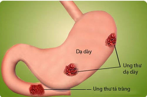 6 dau hieu canh bao ung thu da day khong duoc bo qua - 1