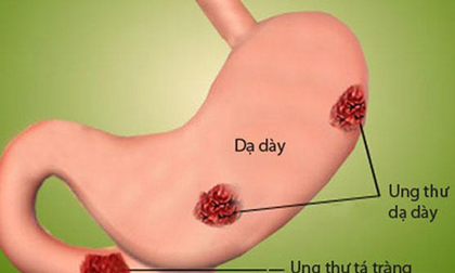 6 dấu hiệu cảnh báo ung thư dạ dày không được bỏ qua