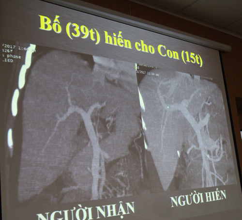 Trong giây phút cận kề “cửa tử”, người cha hiến một phần cơ thể để giữ lại sự sống cho con - 1
