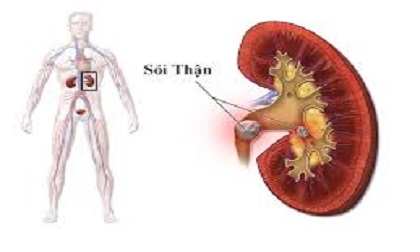 Cách hay chữa sỏi thận cấp tốc, an toàn bằng nguyên liệu tự nhiên ít ai ngờ