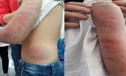 Thi hành lệnh bắt ông bố tàn độc đánh con gái nhập viện