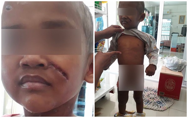 Rùng mình bé 3 tuổi bị cha dượng tra tấn như thời trung cổ, mẹ chỉ biết im lặng - Ảnh 1.