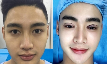 Diện mạo mới của chàng trai 9X giấu mẹ đi thẩm mỹ hết 200 triệu