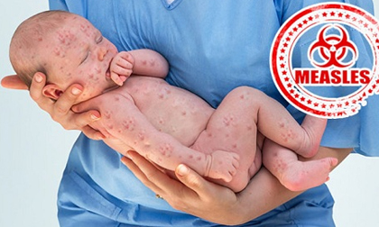 10 căn bệnh tưởng đã biến mất nhưng vẫn đe dọa loài người