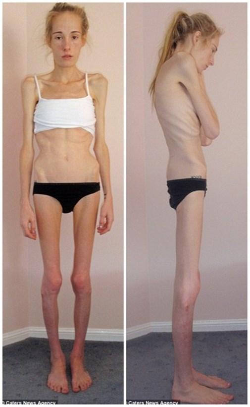 Cô gái gầy xiêu gầy đổ, suýt chết vì chứng biếng ăn năm xưa giờ ra sao? - Ảnh 2.