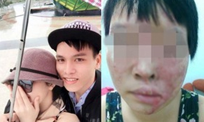 Hình ảnh mới sau khi tái tạo da của cô sinh viên bị tạt axit bỏng đến 75% gương mặt năm ngoái