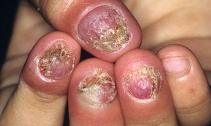 Đua nhau làm nail đẹp chào hè, chị em cần cảnh giác để không rước họa vào thân