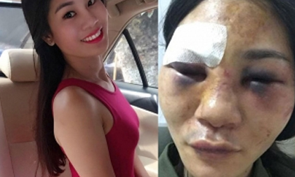 Mẹ đơn thân xinh đẹp bị khách mua hàng online đánh thâm tím mặt mày, nhập viện cấp cứu