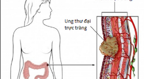 mac cac dau hieu sau, can di kham phat hien ung thu dai truc trang ngay - 1