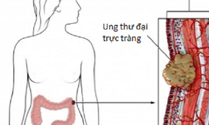 Mắc các dấu hiệu sau, cần đi khám phát hiện ung thư đại trực tràng ngay