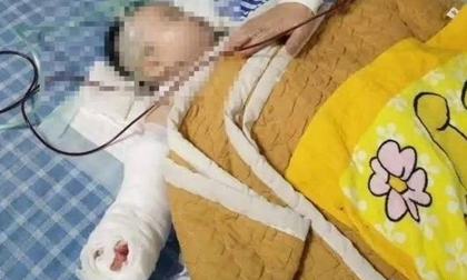 Bé sơ sinh bị bác sĩ cắt mất ngón tay khi đến viện thay băng vết bỏng