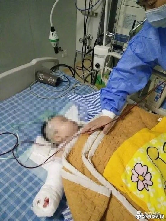 Bé sơ sinh bị bác sĩ cắt mất ngón tay khi đến viện thay băng vết bỏng - Ảnh 2. Bé sơ sinh bị bác sĩ cắt mất ngón tay khi đến viện thay băng vết bỏng - Ảnh 2.