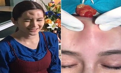 Cảnh 'rợn người': bác sĩ nặn mủ ra khỏi trán bệnh nhân bị biến chứng do tiêm filler không rõ nguồn gốc