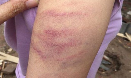 Hà Nội: Học sinh không làm đủ bài tập bị giáo viên đánh tím tay