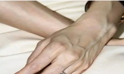 Phụ nữ chớ nên coi thường việc nổi gân xanh trên cơ thể, nhất là trên chân
