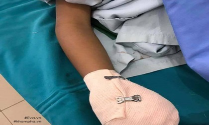 Bé 8 tuổi đau đớn cắt bỏ bàn tay, đã đến lúc cha mẹ dừng ngay việc chơi điện thoại khi sạc
