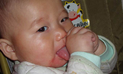 Mẹ trẻ hối hận vì thói quen thả tóc khiến con gái 5 tháng suýt phải cắt bỏ ngón tay