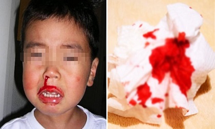 Con trai chảy máu cam đã ngất xỉu và qua đời vì việc làm này của mẹ - hối hận cũng muộn rồi!