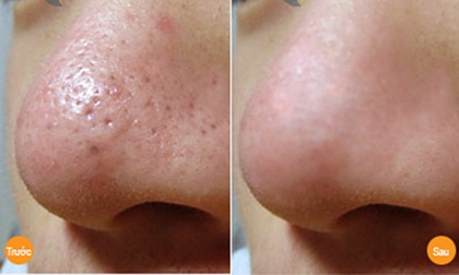Cách trị mụn đầu đen ở mũi với kem đánh răng rất dễ dàng chỉ với 10 phút