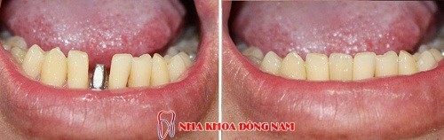 cay-ghep-rang-195-2-xahoi.com.vn-w500-h158