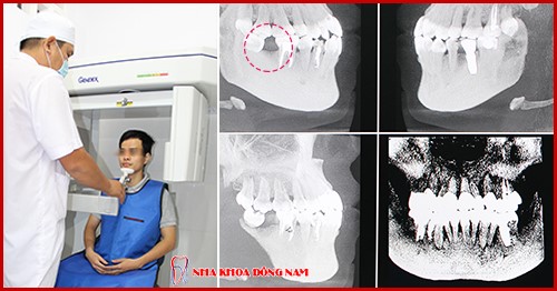 cay-ghep-rang-195-4-xahoi.com.vn-w500-h262
