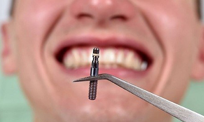 Cấy ghép Implant có tốt không?