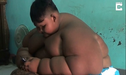 Bé trai phải cắt giảm dạ dày vì ăn nhiều và uống hàng lít nước coca mỗi ngày