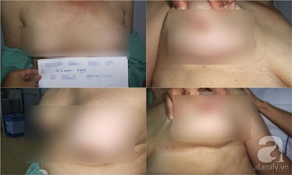 Những hiểm họa sau phẫu thuật nâng ngực khiến ai nhìn cũng khiếp sợ