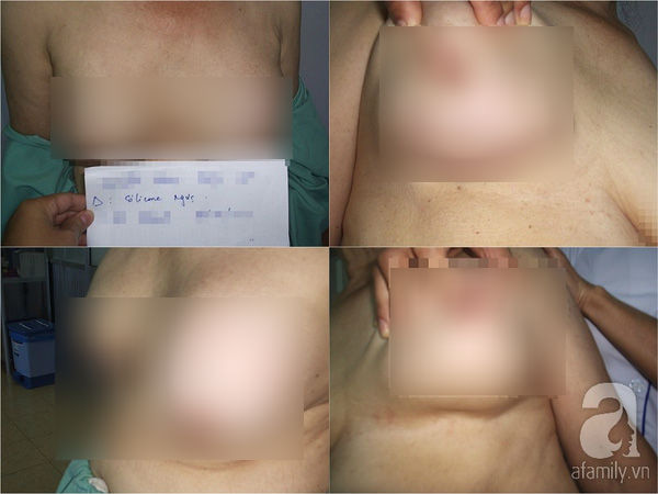 Những hiểm họa sau phẫu thuật nâng ngực khiến ai nhìn cũng khiếp sợ - Ảnh 16. Những hiểm họa sau phẫu thuật nâng ngực khiến ai nhìn cũng khiếp sợ - Ảnh 16.