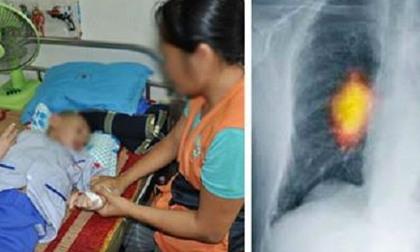 Bé mới 5 tuổi đã bị ung thư phổi giai đoạn cuối, gia đình khóc khi biết nguyên nhân