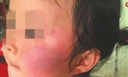 Không nghe lời, 2 bé mầm non bị cô giáo phạt tự tát nhau sưng mặt
