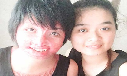 9x sống sót sau khi bị chồng tưới xăng đốt: “Da tôi bị hoại tử, khó có thể tự sản sinh”