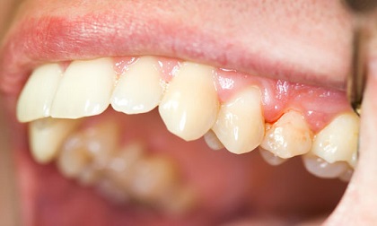 Chảy máu chân răng biểu hiện của bệnh cực kỳ nguy hiểm thậm chí tử vong nếu không đi khám ngay