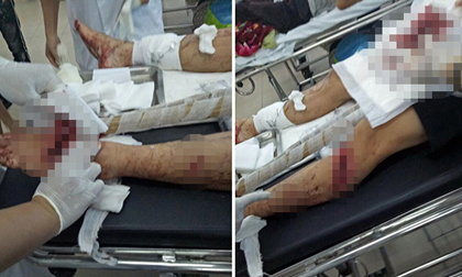Bênh vợ bị đánh, chồng bị nhóm “giang hồ” chém nhập viện