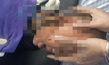 Cha mẹ lơ đễnh, bé trai 2 tuổi bị chiếc kéo cắm ngập tai