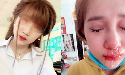 Xôn xao vụ cô gái xinh đẹp tố bạn trai cũ đánh dập mũi, dập môi vì không chịu nghe lời
