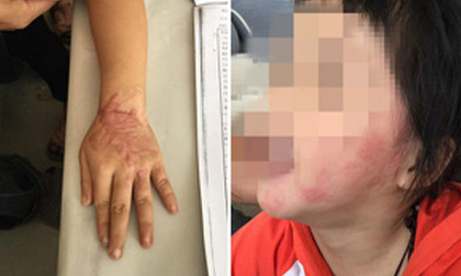 Bé gái 5 tuổi bị bỏng vì điện thoại phát nổ trong lúc ngủ, công ty điện thoại phớt lờ