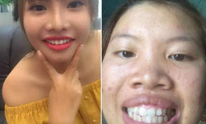 Phượng 'Thị Nở' khoe răng cũ để PR răng mới nhờ chi tiền 'khủng'?