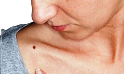 Những nốt ruồi son mang lại may mắn, tài lộc cấm không được tẩy xóa  